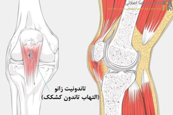 علائم تاندونیت زانو