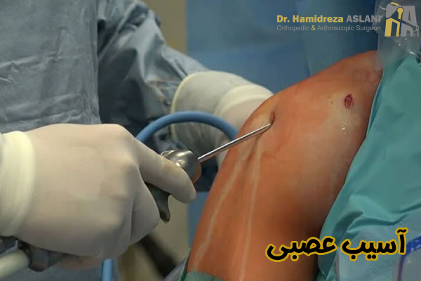 آسیب عصبی
