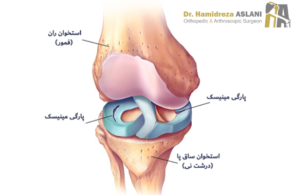 دلایل پارگی مینیسک زانو