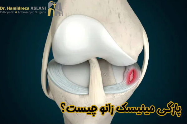 پارگی مینیسک زانو چیست