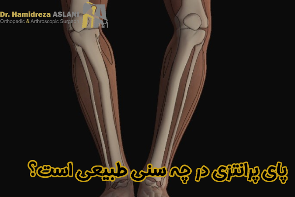 پای پرانتزی در چه سنی طبیعی است؟