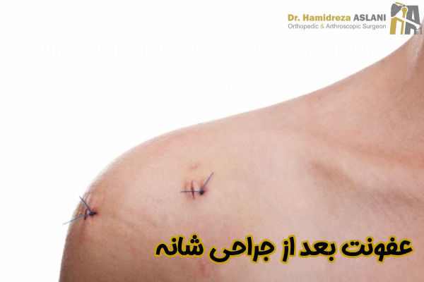 عفونت بعد از جراحی شانه