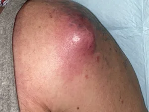 عفونت بعد از جراحی شانه