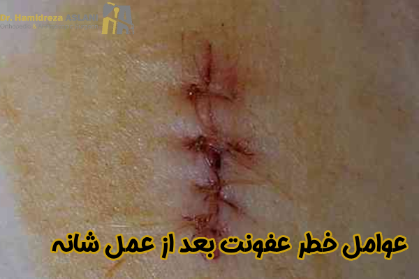 عوامل خطر عفونت بعد از عمل شانه