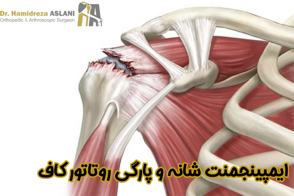 ایمپینجمنت شانه پارگی روتاتور کاف