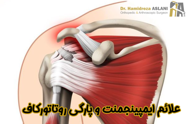 علائم ایمپینجمنت و پارگی روتاتورکاف