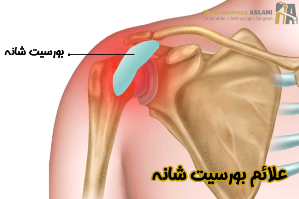 علائم بورسیت شانه