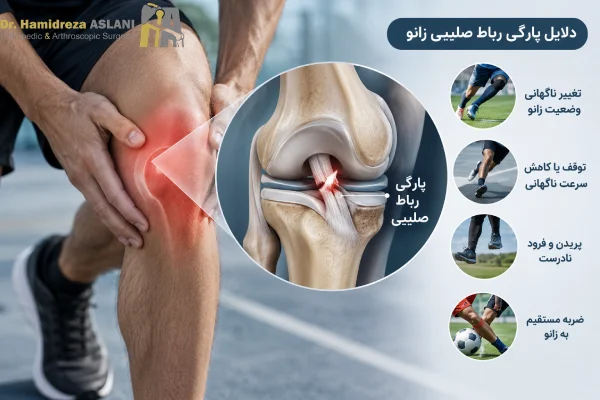 علت پارگی رباط صلیبی زانو